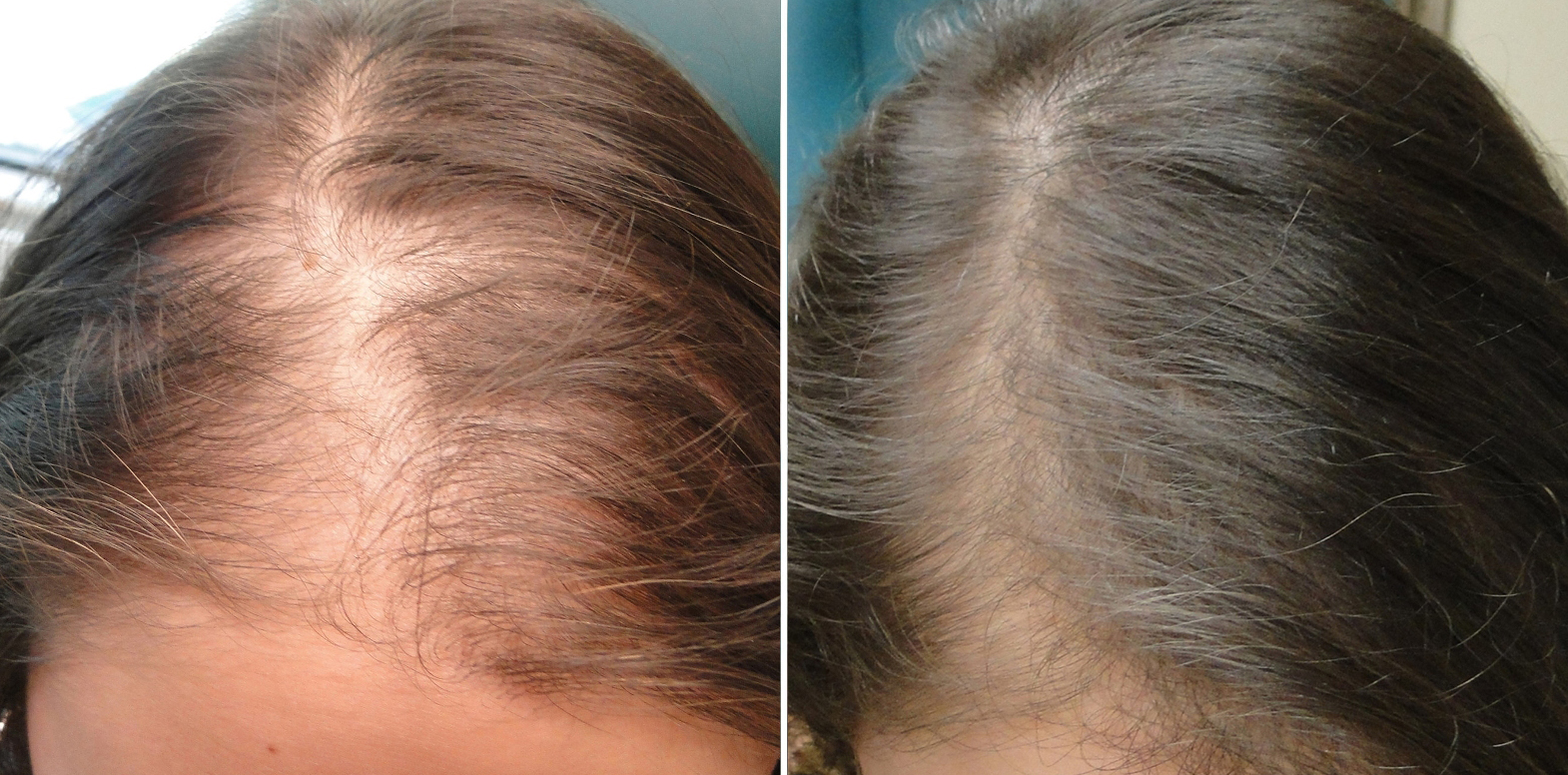 Hair Restoration Bellezza Medical Aesthetics