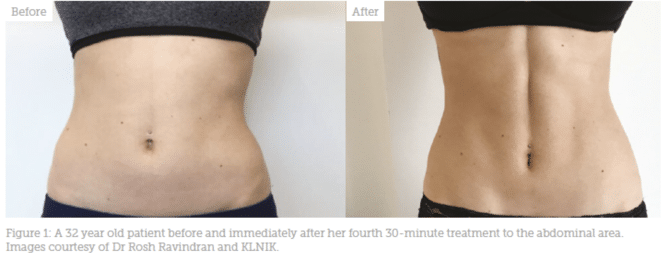 Non-Surgical Body Contouring, Emsculpt in Reston VA